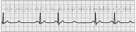 second degree type 2 – We're All Med Here